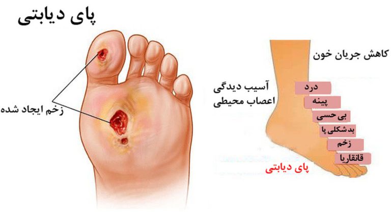 درمان پای دیابتی