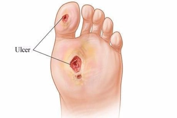 زخم دیابتی چیست