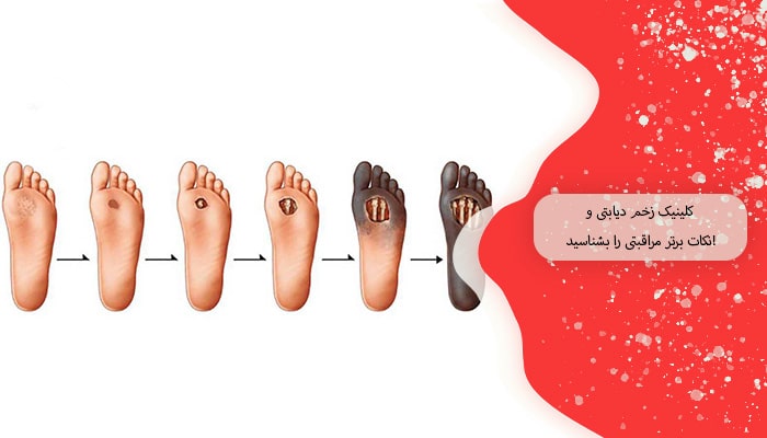 کلینیک زخم دیابتی و نکات برتر مراقبتی را بشناسید! 3 کلینیک زخم دیابتی و نکات برتر مراقبتی را بشناسید!
