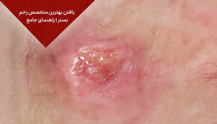 یافتن بهترین متخصص زخم بستر 1 راهنمای جامع 5 یافتن بهترین متخصص زخم بستر 1 راهنمای جامع