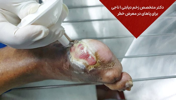 دکتر متخصص زخم دیابتی 1 ناجیانی برای پاهای در معرض خطر