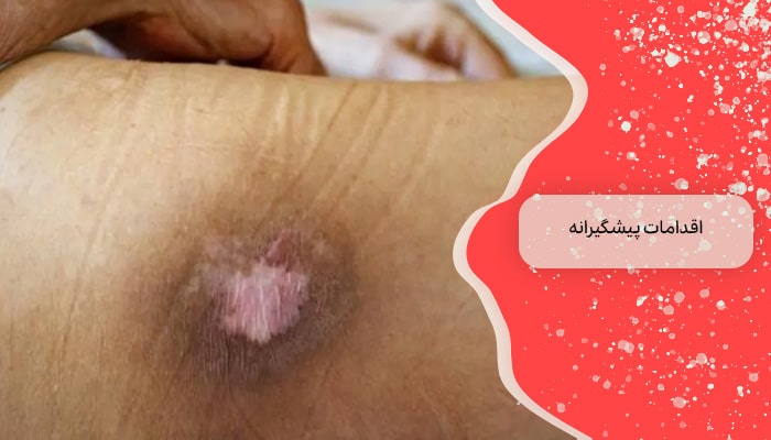 پیشگیری از خطرات جدی زخم بستر
