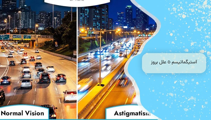 آستیگماتیسم 5 علل بروز