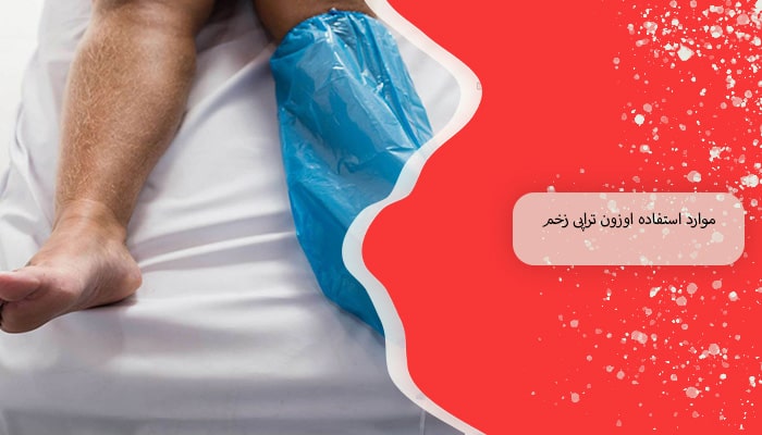 اوزون تراپی زخم 1 راهکار نوین در درمان زخم های مزمن 1 موارد استفاده اوزون تراپی زخم